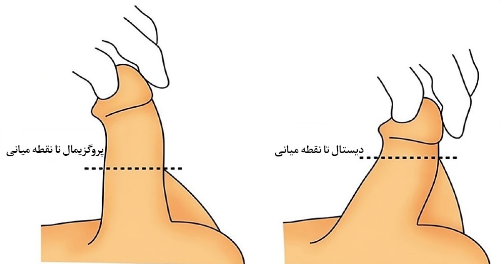 آلت تناسلی پرده‌دار