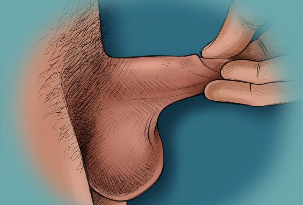 علائم آلت تناسلی پرده‌دار