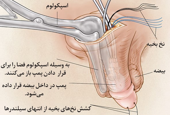 نحوه جراحی پروتز آلت تناسلی