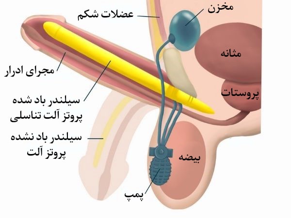 پروتز آلت تناسلی چیست