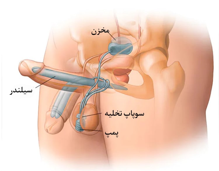 پروتز سه تکه آلت تناسلی