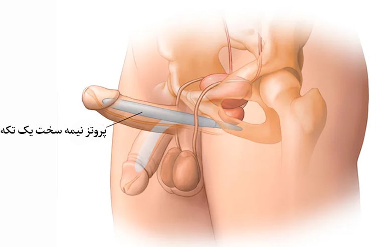 پروتز یک تکه آلت تناسلی