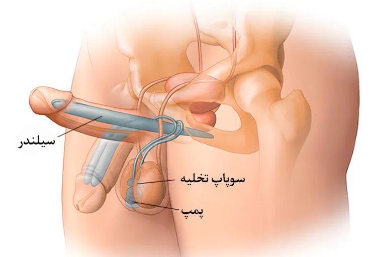 پروتز‌ دو تکه آلت تناسلی