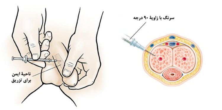 درمان شلی یا راست نشدن آلت با تزریق دارو 3