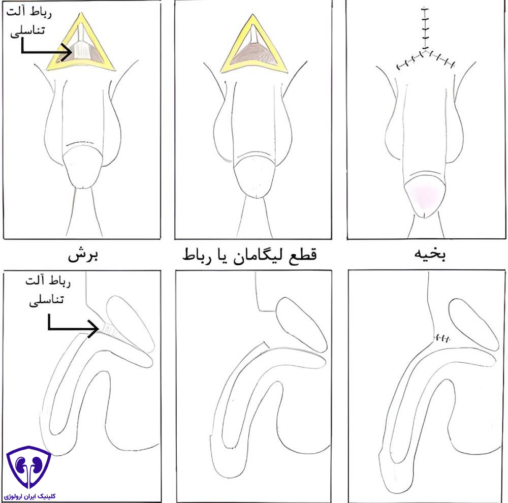 نحوه انجام جراحی قطع لیگامان