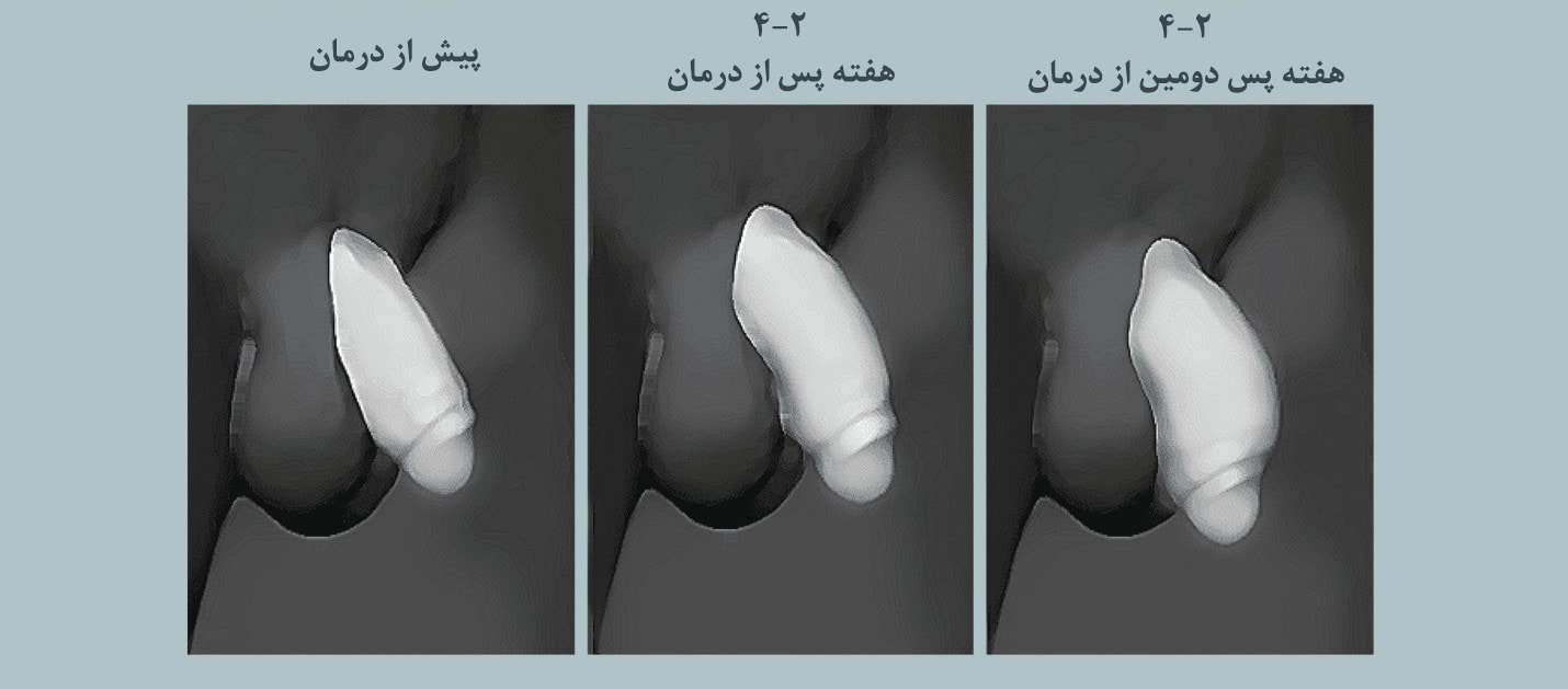 بزرگ کردن آلت تناسلی با تزریق ژل یا فیلر
