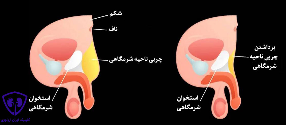 بزرگ کردن آلت با لیپوساکشن