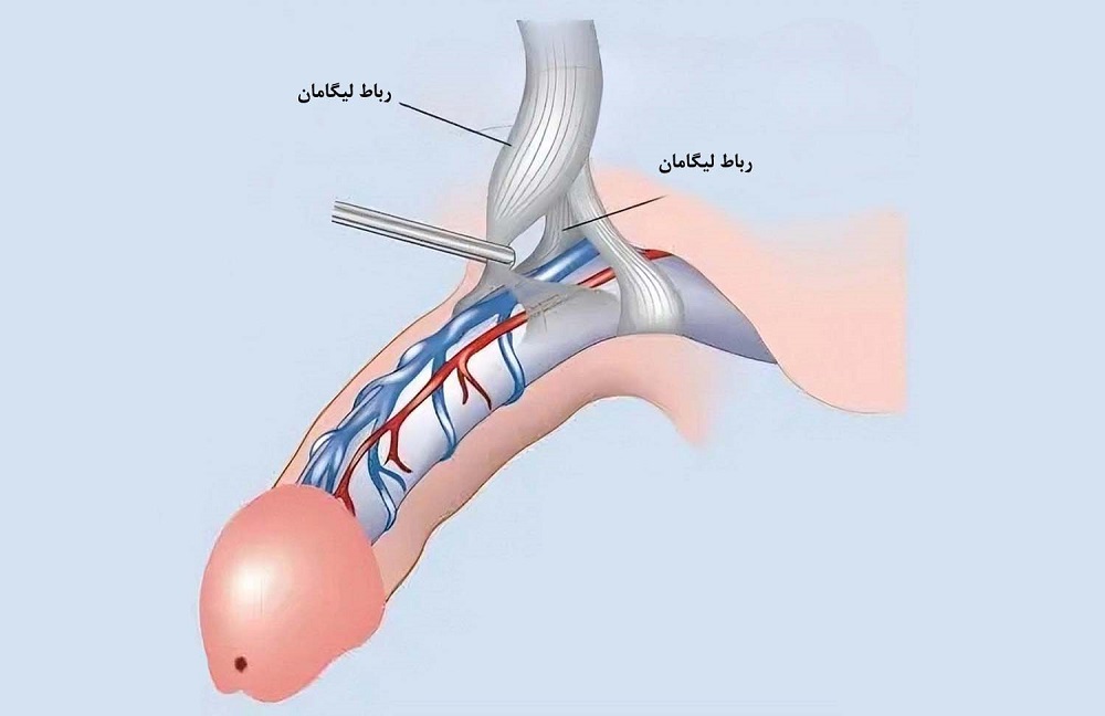 جراحی قطع لیگامان