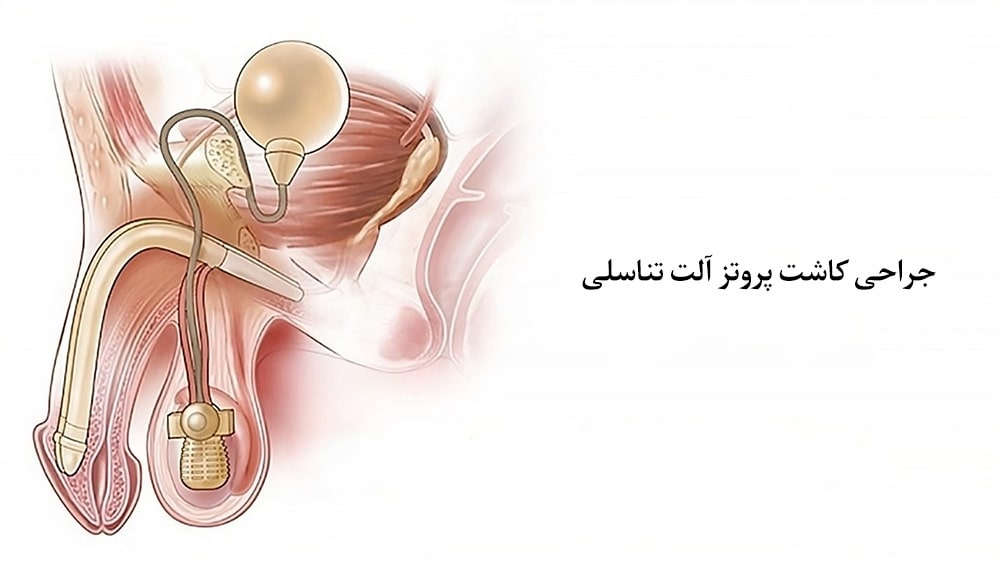 درمان اختلال نعوظ با جراحی