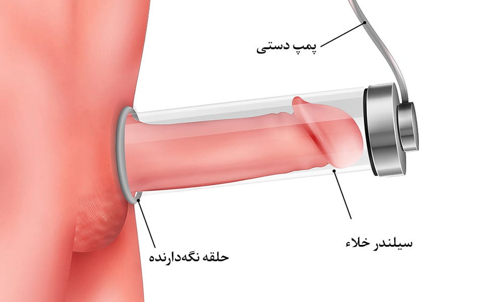 دستگاه وکیوم مردانه