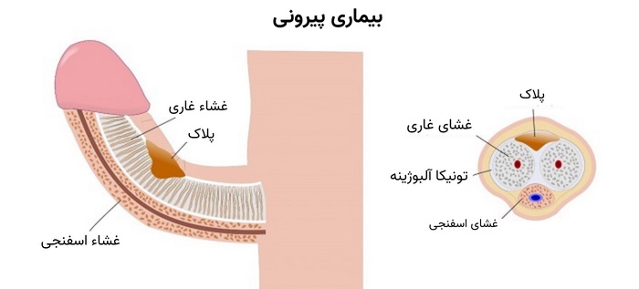  کجی آلت تناسلی