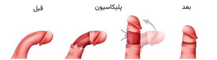 جراحی پلیکاسیون