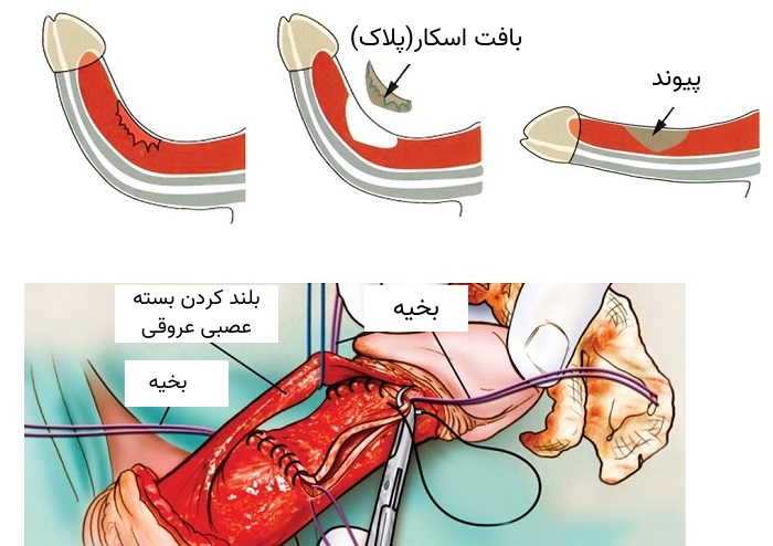 جراحی پیوند بیماری پیرونی