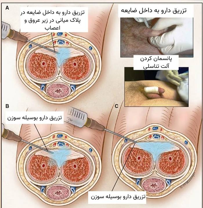 درمان تزریقی بیماری پیرونی