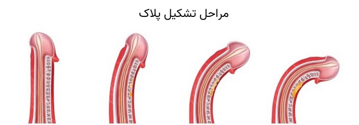 مراحل پیشروی بیماری پیرونی