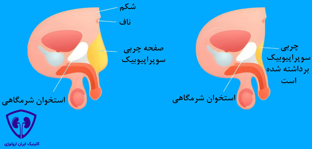 مراحل جراحی لیپکتومی سوپراپوبیک 