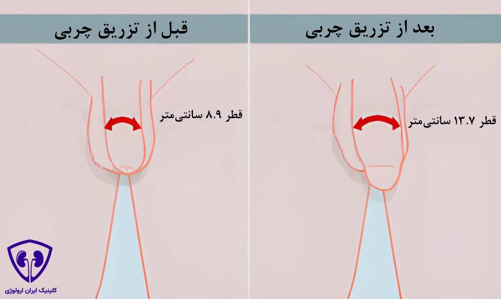 تزریق چربی به آلت تناسلی 