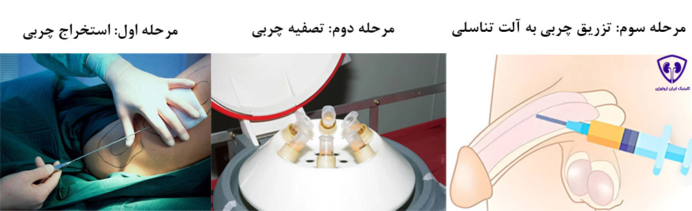 تزریق چربی به آلت تناسلی به چه صورت انجام می‌شود؟ 