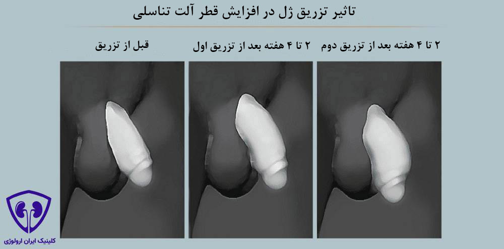 تاثیر تزریق ژل در افزایش قطر آلت تناسلی