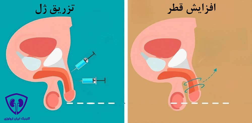 تزریق ژل برای افزایش قطر آلت تناسلی