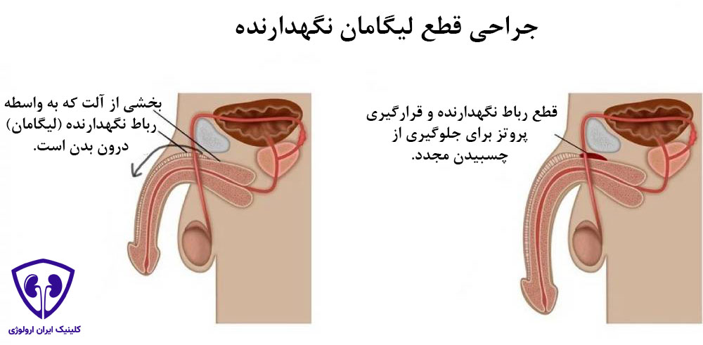 افزایش طول آلت تناسلی با جراحی قطع لیگامان