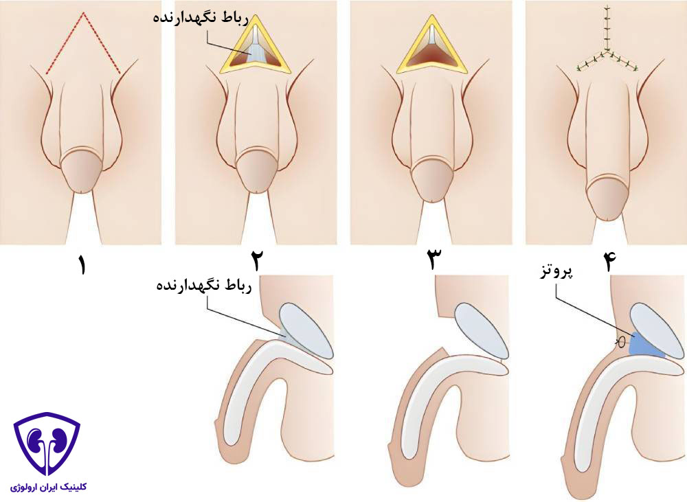 مراحل انجام جراحی قطع لیگامان 