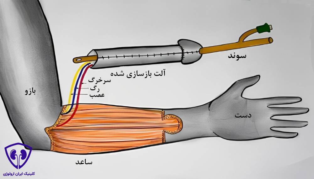 جراحی بازسازی آلت تناسلی