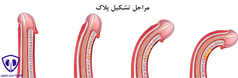 بیماری پیرونی
