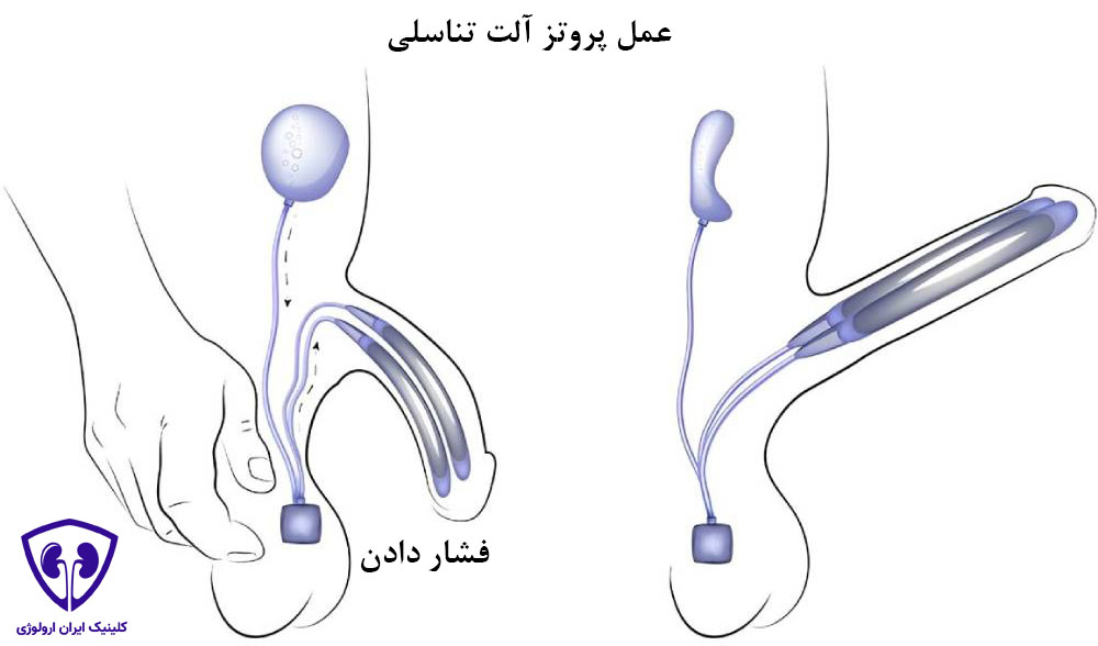 جراحی پروتز آلت تناسلی