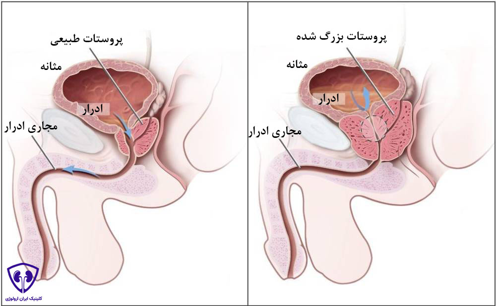 جراحی پروستات